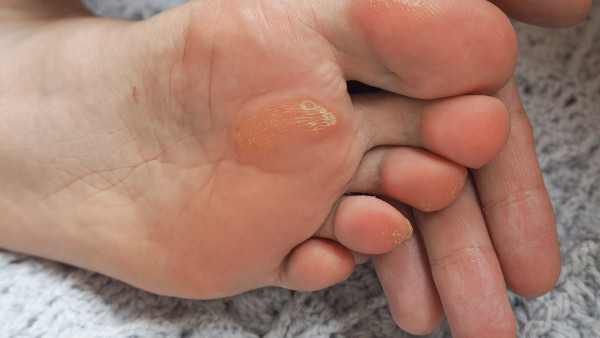 脚气怎么治好得快(图1) 脚气怎么治好得快(图1)