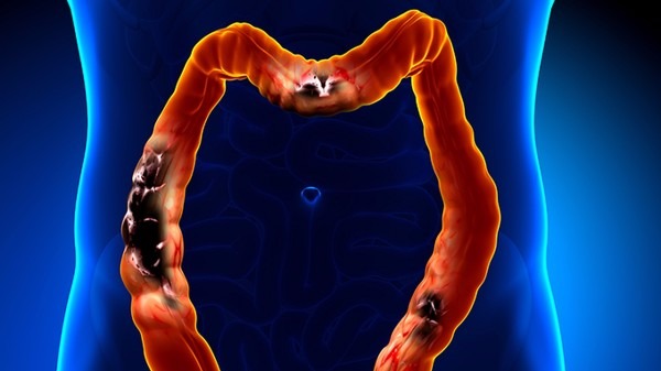 吃3年酵素大肠表面宛若蛇皮 这样治疗便秘可不靠谱&nbsp;