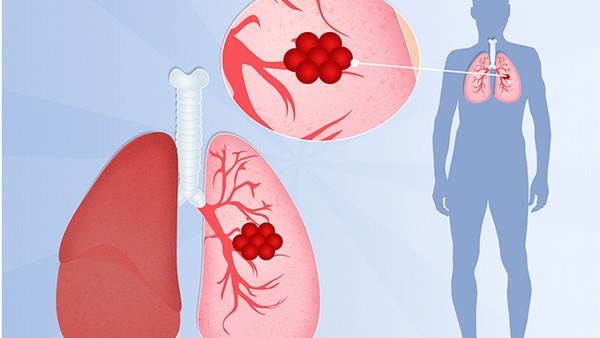 肺癌病人日常护理需要注意什么?护理肺癌患者注意3个事项