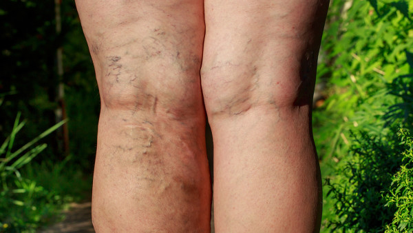 痛风患者应禁食哪些食物 痛风患者能吃苋菜吗