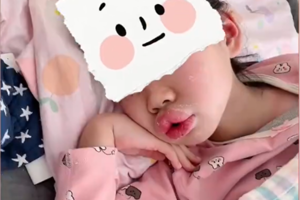9岁女孩吃布洛芬后嘴巴红肿，上网查了是过敏，吃抗过敏药已消肿