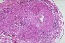 巨細(xì)胞動(dòng)脈炎