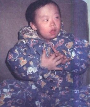 精神發(fā)育遲緩