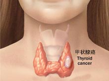 甲状腺癌