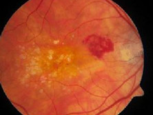 脈絡(luò)膜新生血管