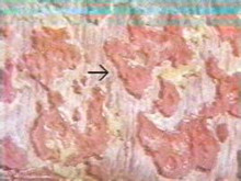 慢性細菌性痢疾