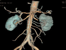 腎動(dòng)脈栓塞