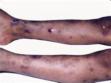 血栓性血小板減少性紫癜