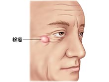 粉瘤