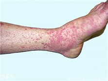 變應(yīng)性皮膚血管炎