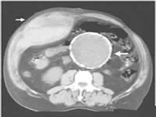 腹直肌鞘內(nèi)血腫