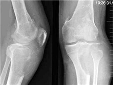 骨纖維結(jié)構(gòu)不良