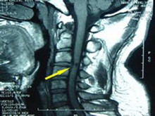 急性化膿性脊髓炎