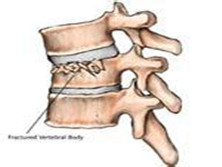 脊柱關(guān)節(jié)炎