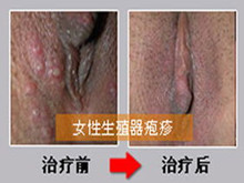 妊娠合并生殖器疱疹