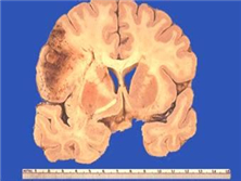 神經(jīng)元蠟樣脂褐質(zhì)沉積癥