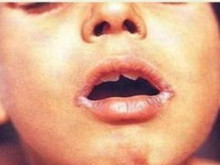 小兒維生素B2缺乏病