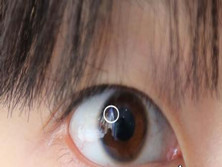 眼球表面异物
