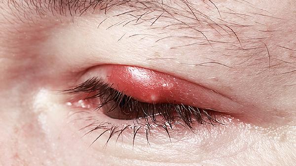 眼睛里长白色小颗粒有时候很疼