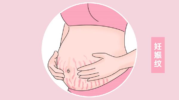 生完之后妊娠紋什么樣子 怎樣防治妊娠紋