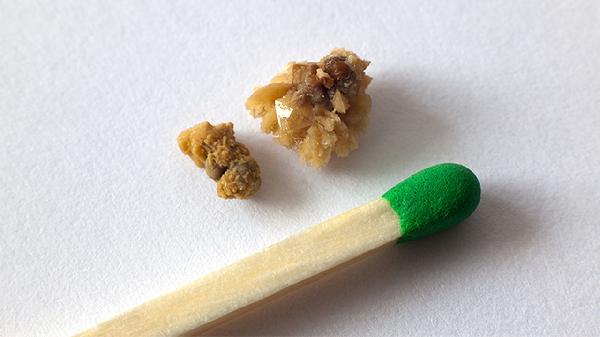 膽總管下段結(jié)石會自己掉么