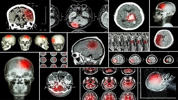 良性腦腫瘤的癥狀有哪些 良性腦腫瘤的3個癥狀細說
