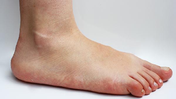 緩解療糖尿病足最佳方法是什么