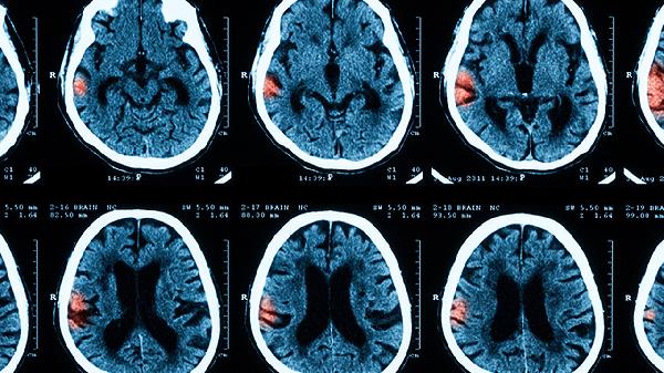 化膿性腦膜炎的治療方法是什么