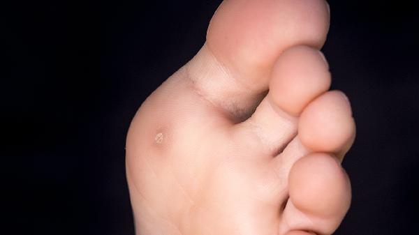 雞眼膏怎么用 介紹雞眼膏的3大正確用法