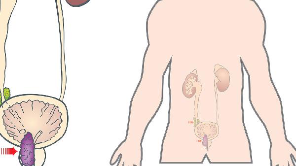 腎結(jié)石怎么才能完全清除干凈 三個(gè)方法消除腎結(jié)石