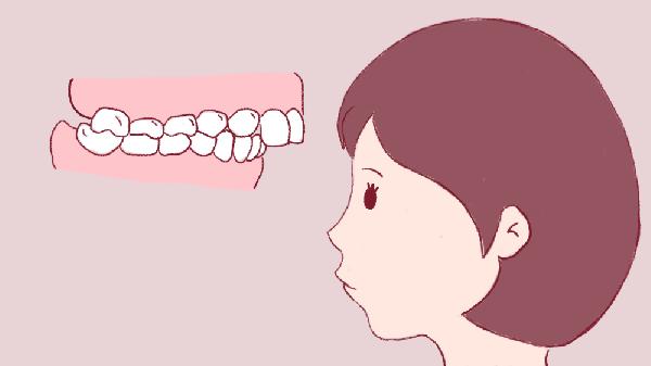 30歲地包天牙齒還能矯正嗎