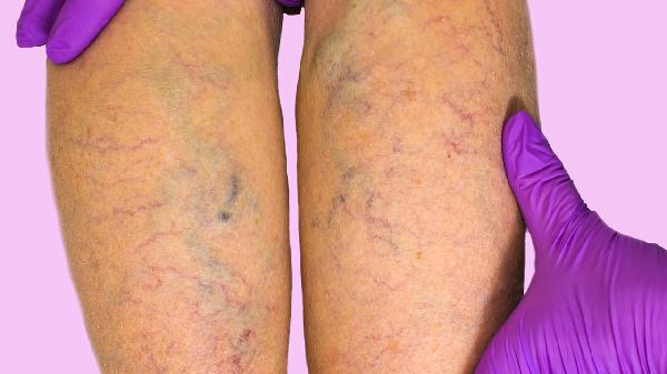 大腿内侧股癣好治吗 揭秘快速治愈大腿内侧股癣方法