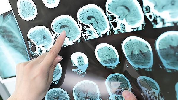 精神分裂癥患者大腦與正常人的區(qū)別有哪些