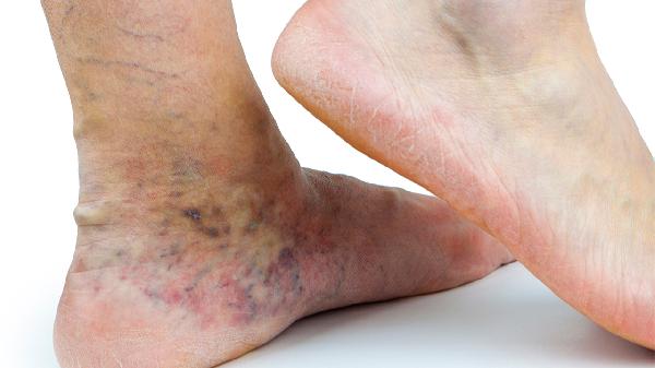 老寒腿怎樣治療 四個方法減輕老寒腿病情