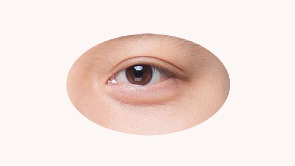 雙眼皮術(shù)后可以用蒸汽眼罩敷眼嗎