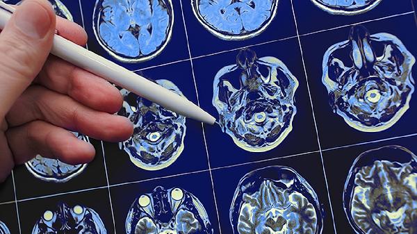 先天性腦積水能治好嗎 4個方法有效控制先天性腦積水