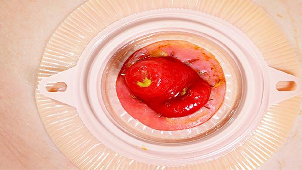 有食管裂孔疝哪些運(yùn)動(dòng)不能做