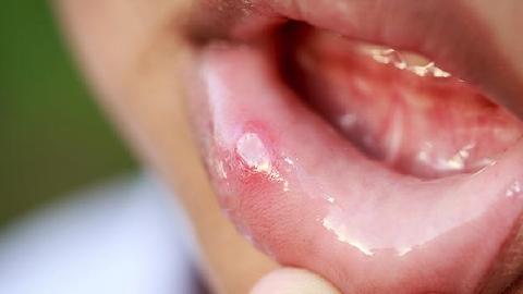 15岁孩子得了胃溃疡怎么办