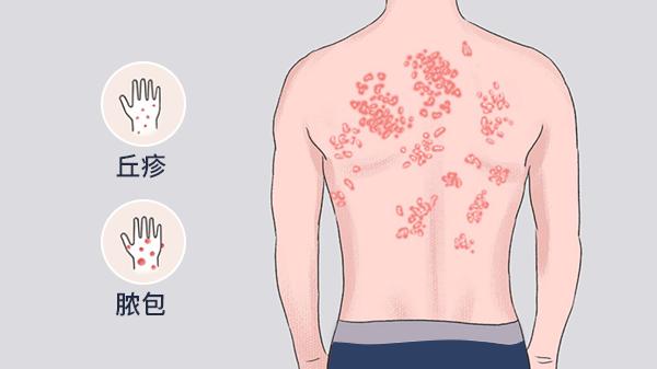活血通络治疗顽固性皮肤病效果怎么样