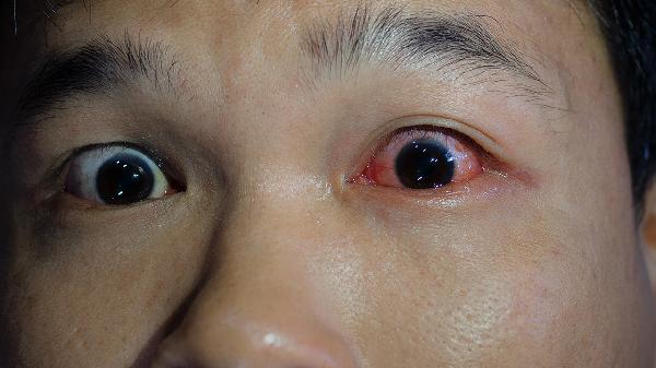 怎么预防红眼病复发 预防红眼病6招全都告诉你