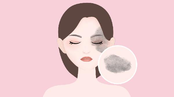 導(dǎo)致太田痣出現(xiàn)的原因有哪些
