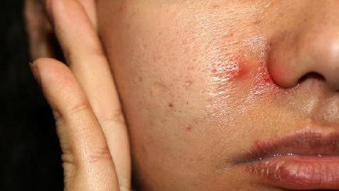异位性皮炎的具体治疗方法有哪些