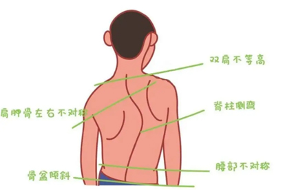 脊柱侧弯怎么恢复