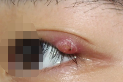 嬰兒得了麥粒腫怎樣治療好