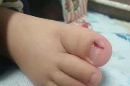 甲沟炎的病因是什么