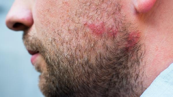 臉上痘印黑色素沉淀怎么去除