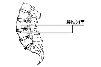 如何避免腰椎间盘突出症