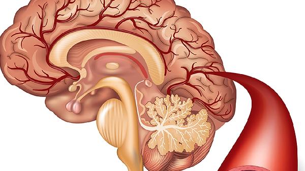 孩子先天性腦血管畸形能治好嗎