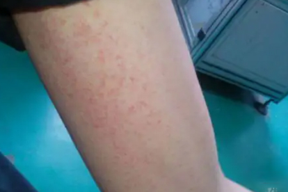 毛囊炎如何治疗好
