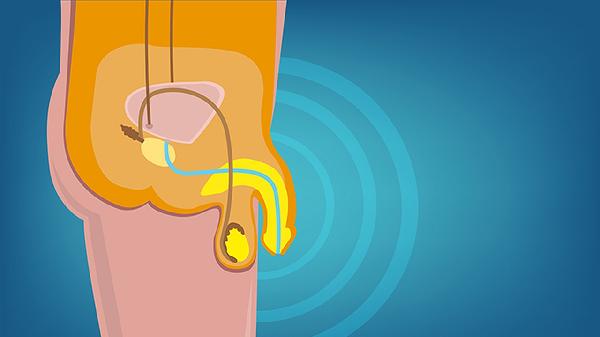 如何治療慢性睪丸附睪炎